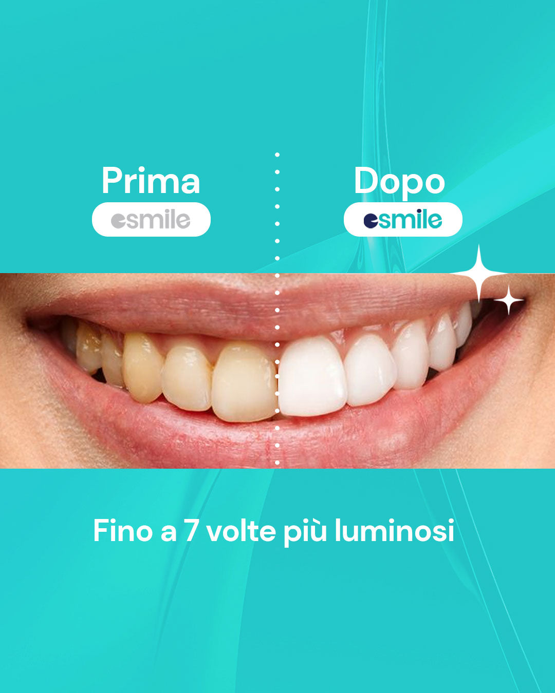 Strisce Sbiancanti Professionali (14 Strisce)