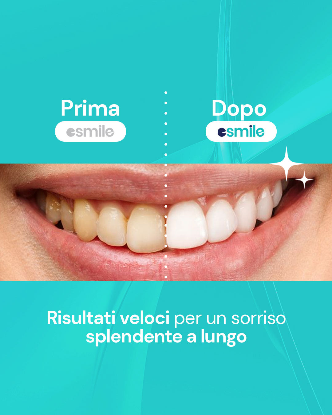 Kit Sbiancante per Denti Professionale
